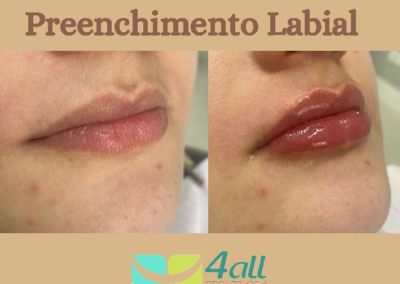 Preenchimento Labial